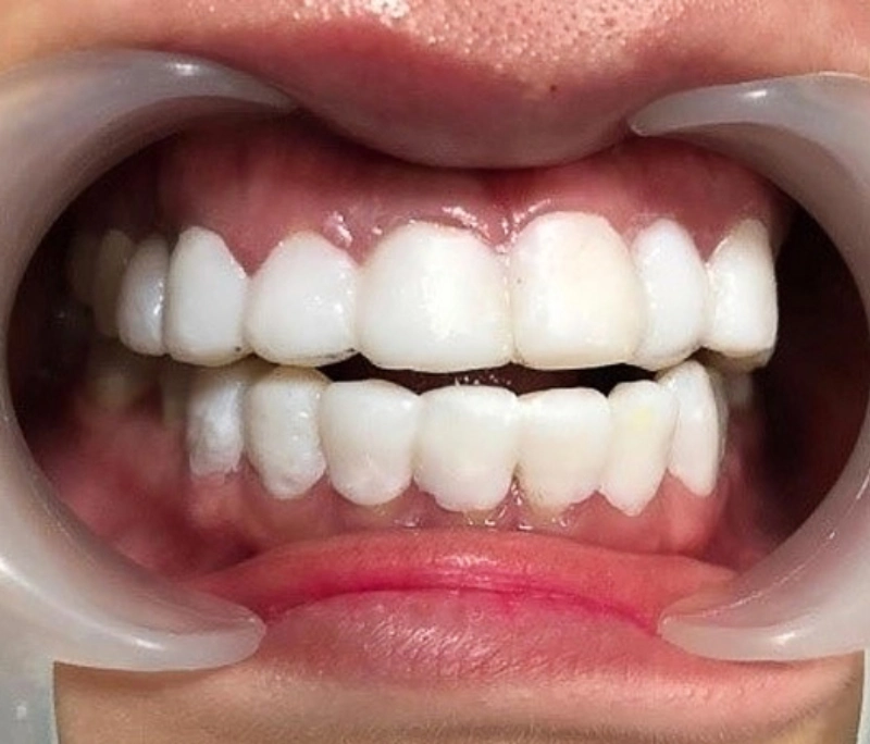 Phủ sứ Nano là gì? Sự thật đằng sau trào lưu thẩm mỹ giá rẻ